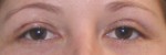 Eyelid Surgery (Blepharoplasty)
