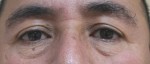 Eyelid Surgery (Blepharoplasty)
