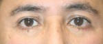 Eyelid Surgery (Blepharoplasty)