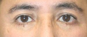 Eyelid Surgery (Blepharoplasty)