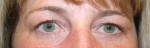 Eyelid Surgery (Blepharoplasty)