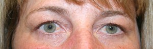 Eyelid Surgery (Blepharoplasty)
