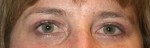 Eyelid Surgery (Blepharoplasty)