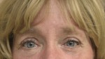 Eyelid Surgery (Blepharoplasty)