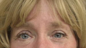 Eyelid Surgery (Blepharoplasty)
