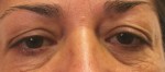 Eyelid Surgery (Blepharoplasty)