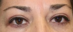 Eyelid Surgery (Blepharoplasty)