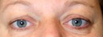 Eyelid Surgery (Blepharoplasty)