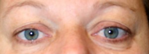 Eyelid Surgery (Blepharoplasty)