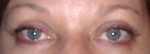 Eyelid Surgery (Blepharoplasty)