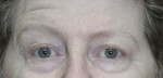 Eyelid Surgery (Blepharoplasty)