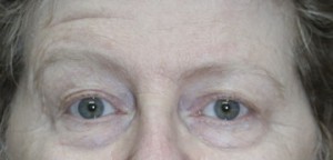 Eyelid Surgery (Blepharoplasty)