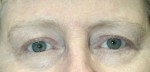 Eyelid Surgery (Blepharoplasty)