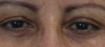 Eyelid Surgery (Blepharoplasty)