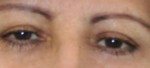 Eyelid Surgery (Blepharoplasty)