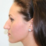 Nose Surgery (Rhinoplasty)