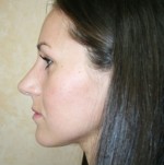 Nose Surgery (Rhinoplasty)