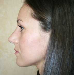 Nose Surgery (Rhinoplasty)
