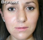 Nose Surgery (Rhinoplasty)