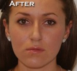 Nose Surgery (Rhinoplasty)