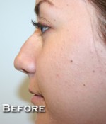 Nose Surgery (Rhinoplasty)