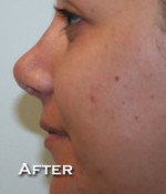 Nose Surgery (Rhinoplasty)