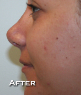 Nose Surgery (Rhinoplasty)