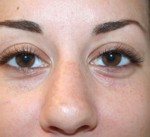 Nose Surgery (Rhinoplasty)