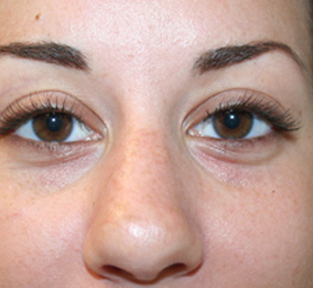 Nose Surgery (Rhinoplasty)