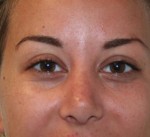 Nose Surgery (Rhinoplasty)