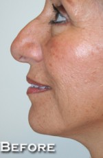 Nose Surgery (Rhinoplasty)