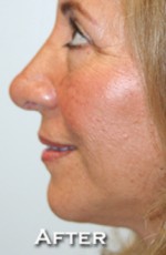 Nose Surgery (Rhinoplasty)