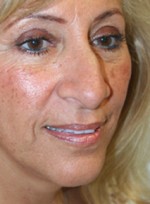 Nose Surgery (Rhinoplasty)