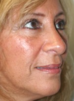 Nose Surgery (Rhinoplasty)