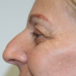 Nose Surgery (Rhinoplasty)