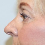Nose Surgery (Rhinoplasty)
