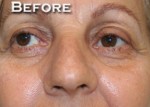 Nose Surgery (Rhinoplasty)