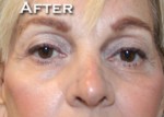 Nose Surgery (Rhinoplasty)