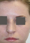 Nose Surgery (Rhinoplasty)