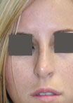 Nose Surgery (Rhinoplasty)