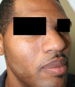 Nose Surgery (Rhinoplasty)