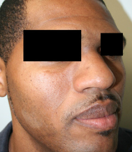 Nose Surgery (Rhinoplasty)
