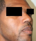 Nose Surgery (Rhinoplasty)