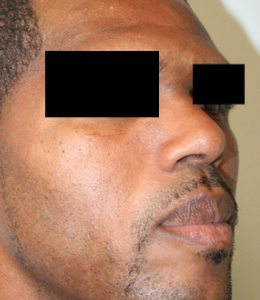 Nose Surgery (Rhinoplasty)