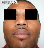 Nose Surgery (Rhinoplasty)