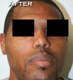 Nose Surgery (Rhinoplasty)