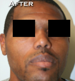 Nose Surgery (Rhinoplasty)