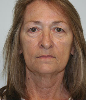 Face Lift