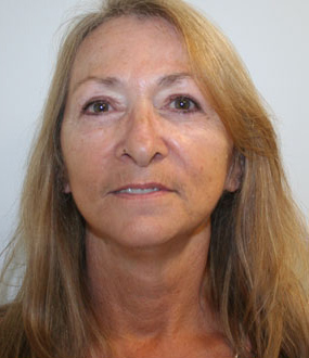 Face Lift