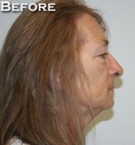 Face Lift